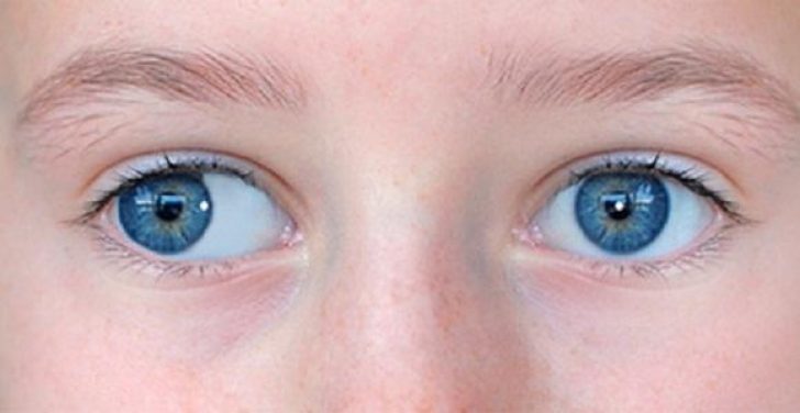 косоглазие у малышей