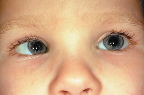косоглазие у младенцев