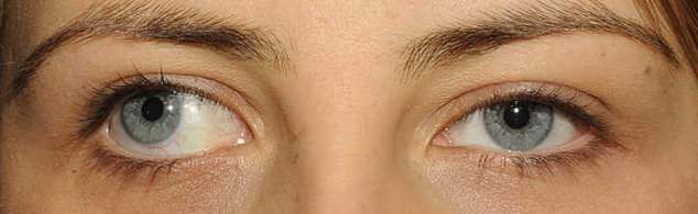 нистагм и косоглазие