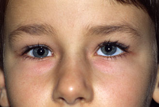 косые глаза у детей