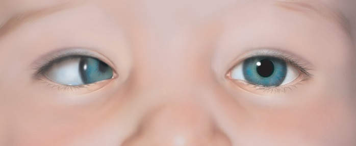 тип косоглазия