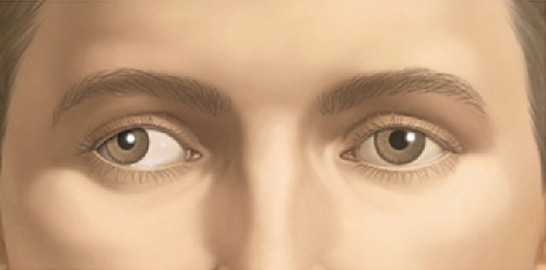 косоглазие и типы