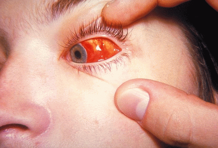 как выглядит кровоизлияние в глаз