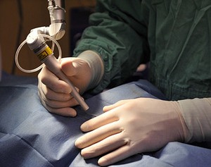 лазер при халязионе