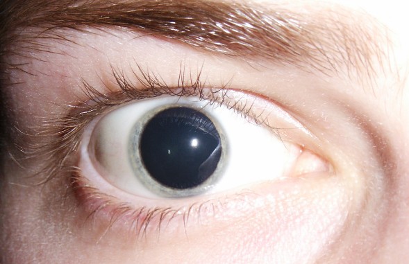 лечение афакии