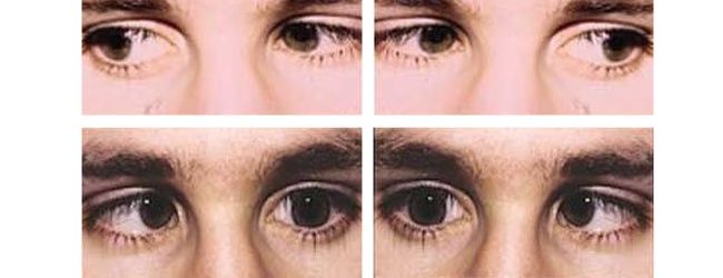 виды нистагма