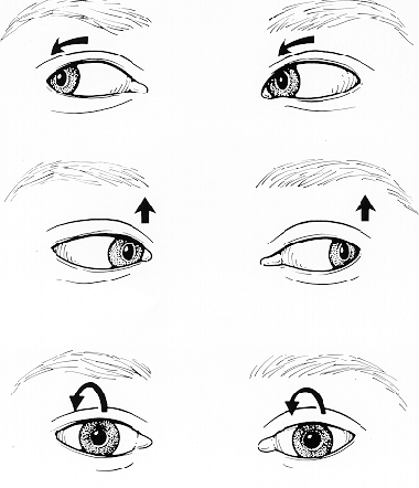 типы нистагма