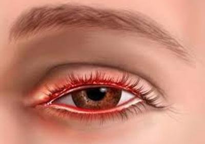 покраснение глаза