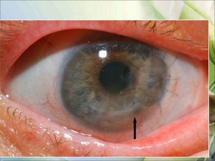 как выглядит отслоение сетчатки