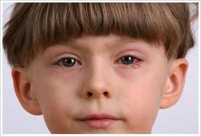 чешуйчатый блефарит ребенка