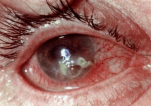 воспаление глаза