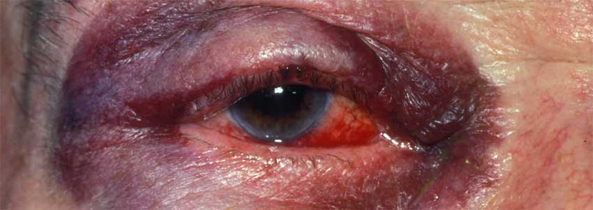 гематома при травме глаза