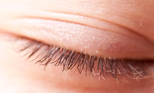 демодекоз век