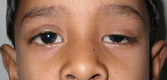 скрытое косоглазие