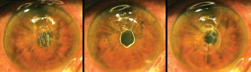 кератотомия