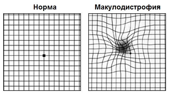 тест амслера