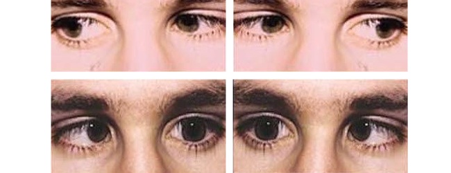 виды нистагма