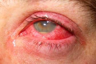 симптомы увеита