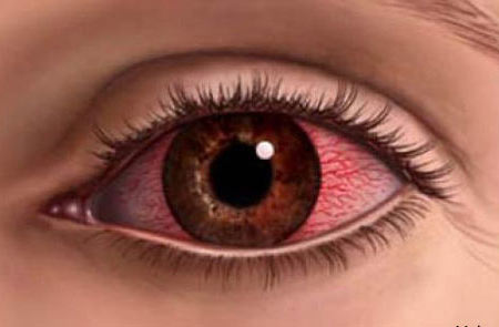 воспаленные глаза