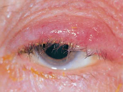 воспаление века