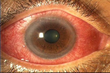 конъюнктивит глаза